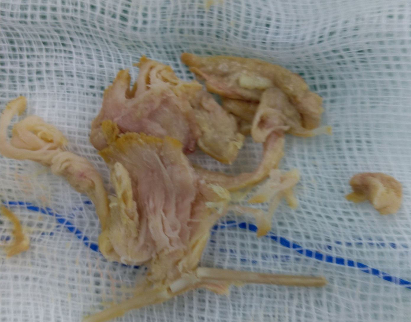 Dị vật được lấy ra từ cổ bệnh nhân. Dị vật được lấy ra từ cổ bệnh nhân.