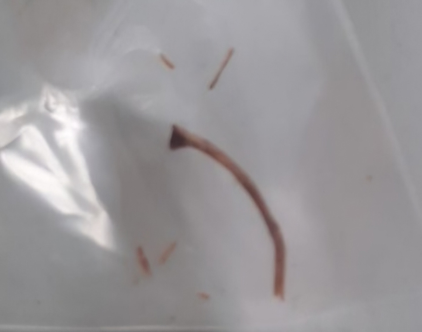 Xương cá lấy ra trong ruột thừa bệnh nhân.