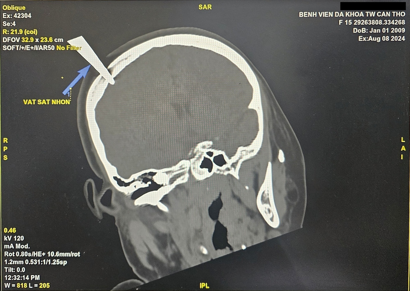 Hình ảnh kéo đâm xuyên qua sọ bệnh nhân.