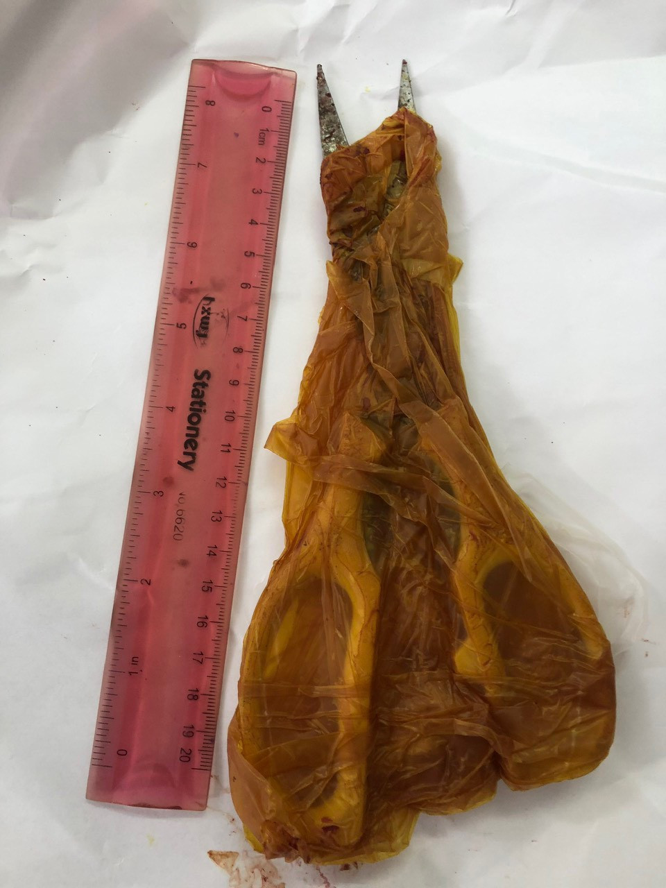 Chiếc kéo được lấy ra sau phẫu thuật.