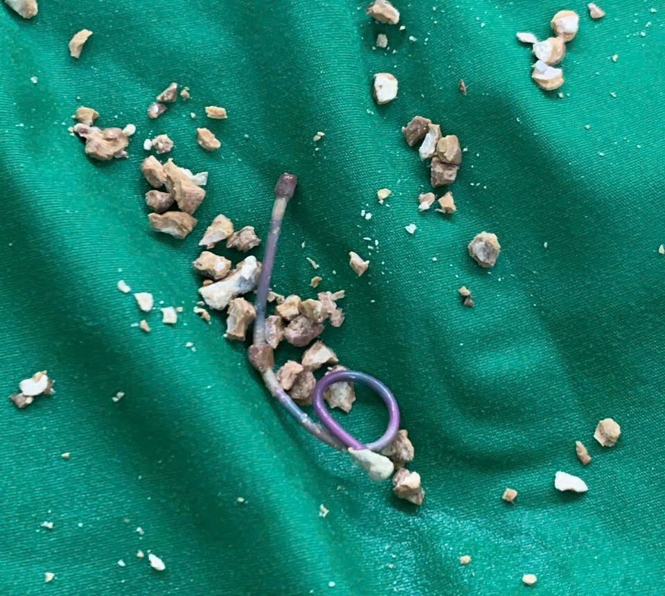 Sỏi và ống thông niệu quản - bàng quang được các bác sĩ Bệnh viện Hoàn Mỹ Cửu Long lấy ra từ người bệnh nhân sau 5 năm bỏ quên.