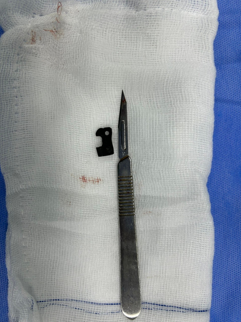 Dị vật của lưỡi cưa máy được lấy ra từ ổ bụng bệnh nhân T. Dị vật của lưỡi cưa máy được lấy ra từ ổ bụng bệnh nhân T.