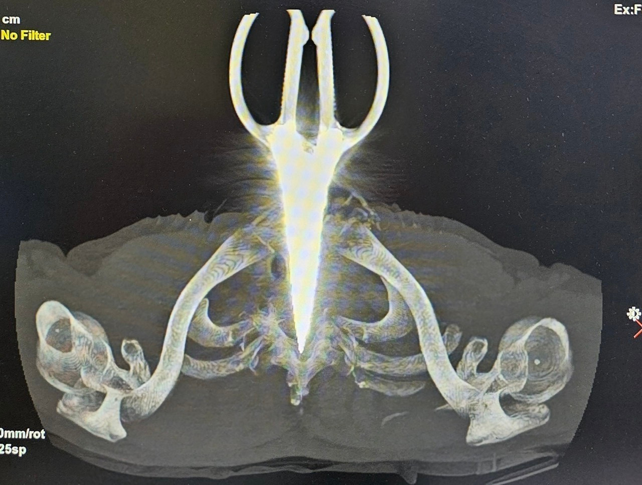 Ảnh phim X-Quang cây kéo dài 24cm đâm cổ bệnh nhân.