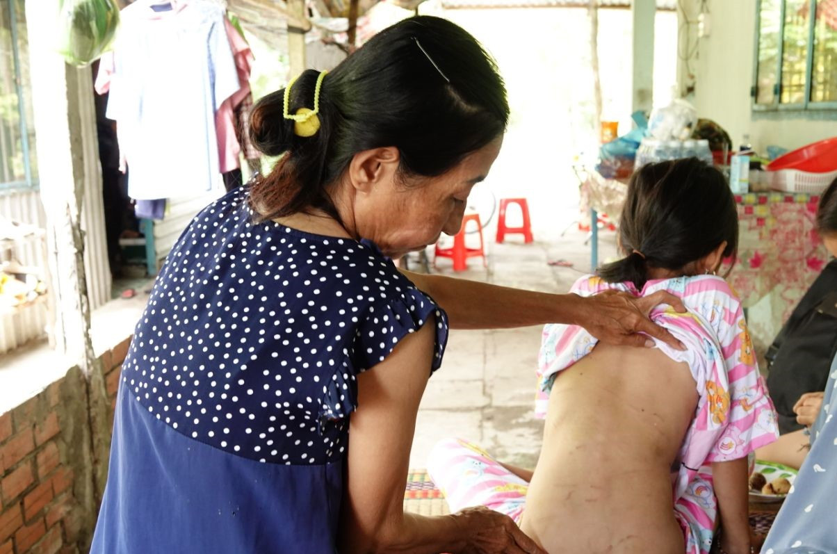 Cơ thể con gái chị H. cũng chi chít vết thương, bé nói do cha dượng gây ra. Ảnh: PV.