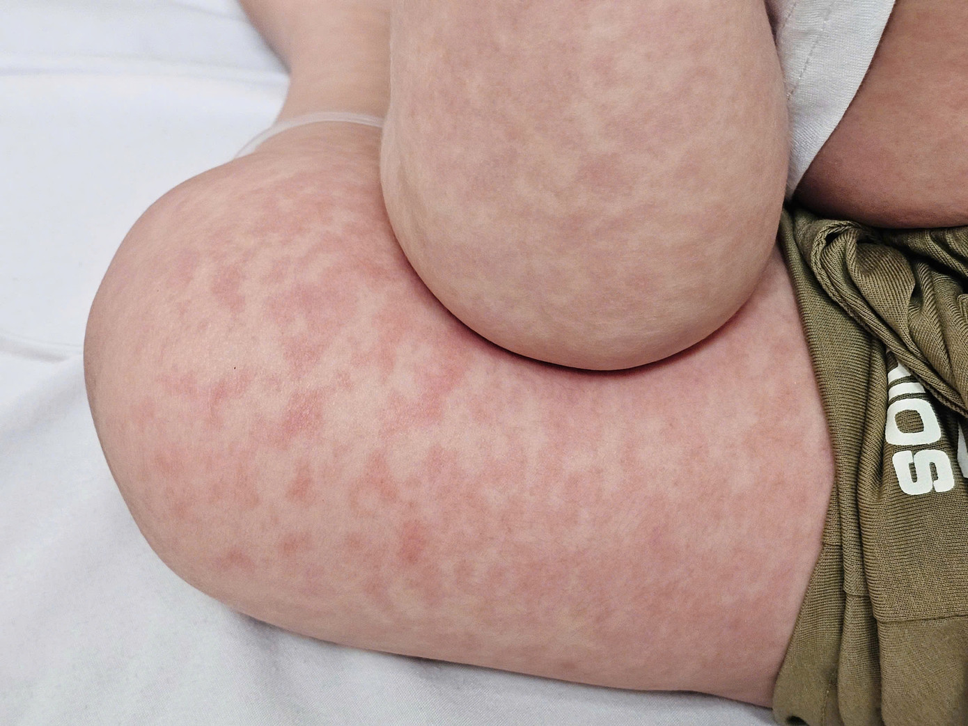 Sởi phát ban trên cơ thể bé.