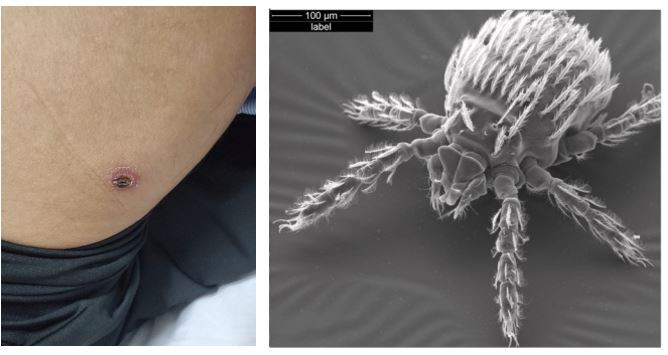 Vết bị về một cắn (bên trái) và bọ ve mò trên kính hiển vi (phải). Vết bị về một cắn (bên trái) và bọ ve mò trên kính hiển vi (phải).