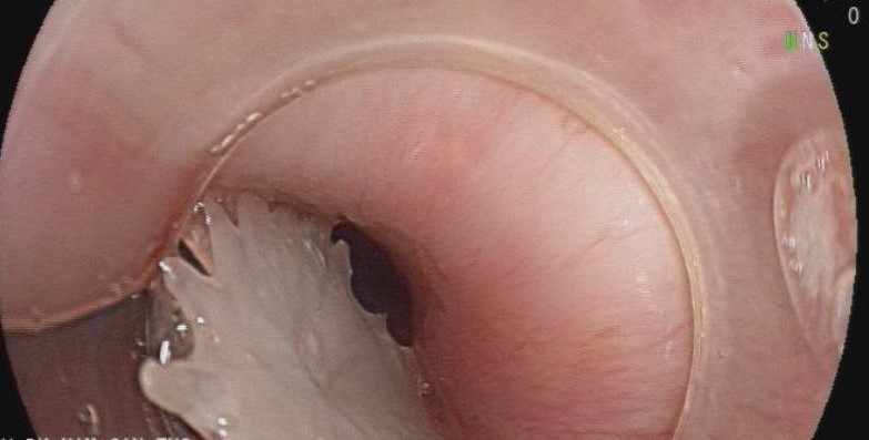 Xương cá trong thực quản Xương cá trong thực quản