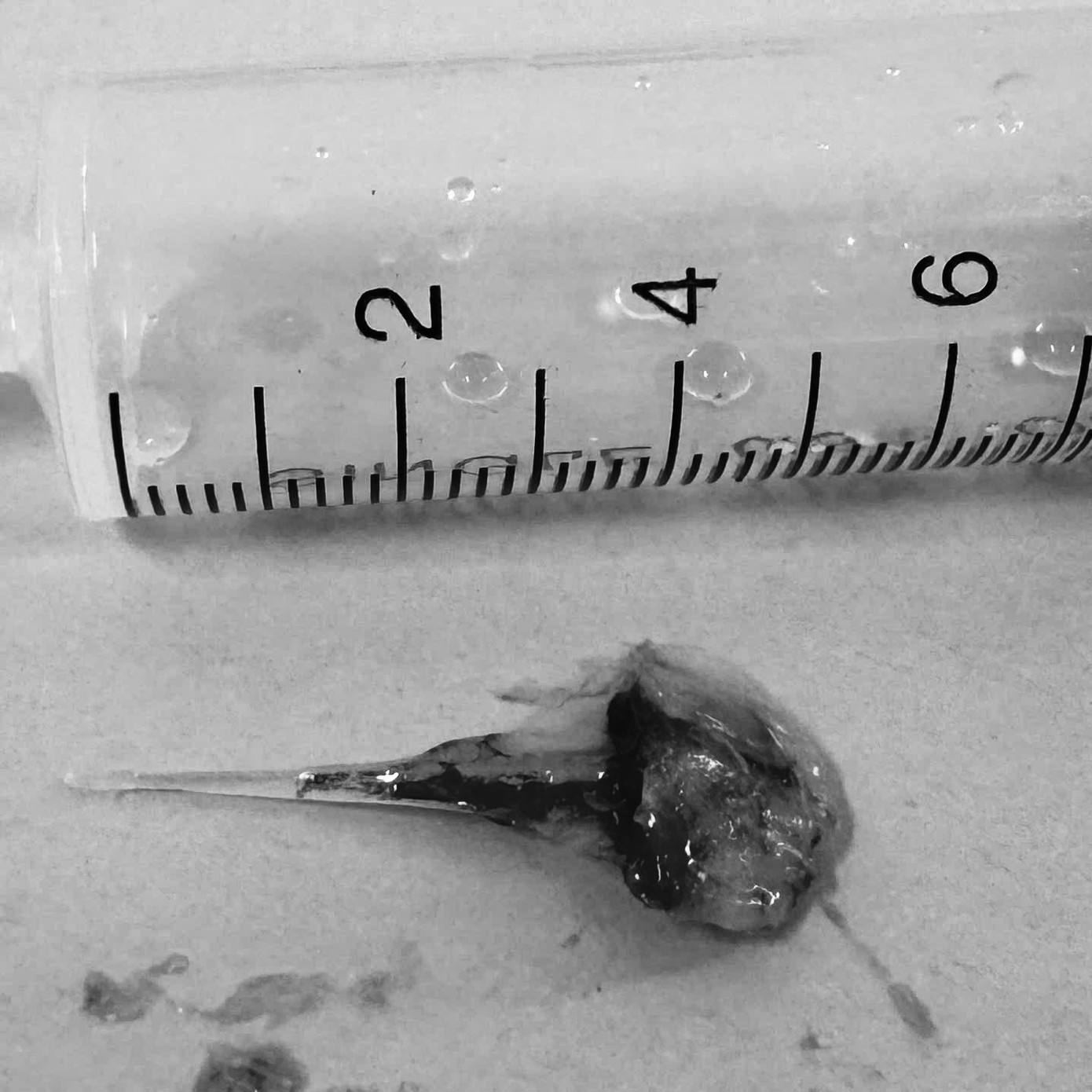 Xương cá dài 6cm đâm vào phế quản ông S. được các bác sĩ lấy ra.