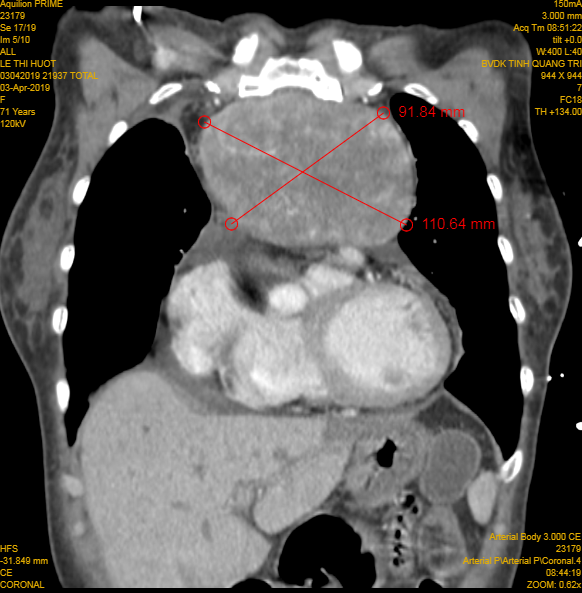 Quảng Trị: Mổ thành công khối u tuyến ức nặng 1kg ở bệnh nhân lớn tuổi ảnh 2