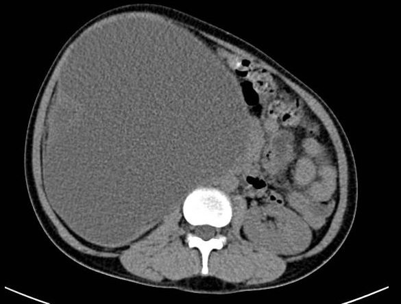 Hình ảnh cắt lớp vi tính của bệnh nhân M. trước lúc phẫu thuật. Ảnh: BVĐKQT Hình ảnh cắt lớp vi tính của bệnh nhân M. trước lúc phẫu thuật. Ảnh: BVĐKQT