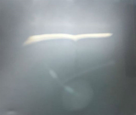  Hình ảnh vòng tránh thai trong bàng quang bệnh nhân. 