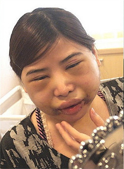 Các bác sĩ nói rằng, vết sưng sẽ trở nên tệ hơn nếu tiến hành nhiều bước phẫu thuật