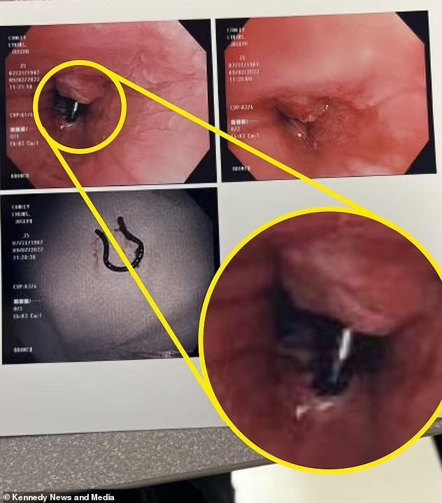 Khuyên mũi của người phụ nữ mắc kẹt trong phế quản. Khuyên mũi của người phụ nữ mắc kẹt trong phế quản.