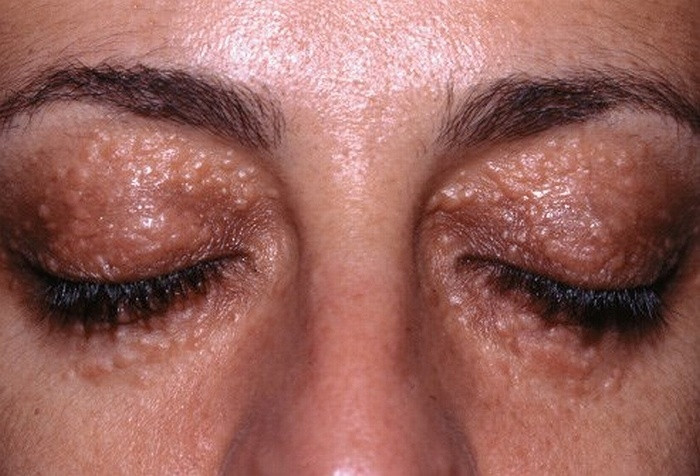  Syringomas là u tuyến lành tính, kích thước từ 1-2 mm, màu da hoặc màu vàng, xảy ra chủ yếu ở phụ nữ. Nó xuất hiện thường xuyên nhất trên mí mắt và trên mặt, rốn, ngực và âm hộ