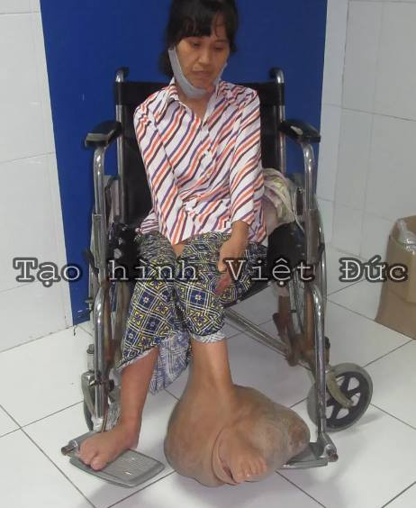 “Giải cứu” cho bệnh nhân mang khối u khổng lồ gần 40 năm ảnh 1