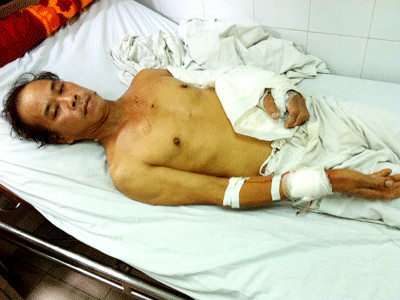 Chú của nạn nhân đang điều trị tại BV Việt Đức. Chú của nạn nhân đang điều trị tại BV Việt Đức