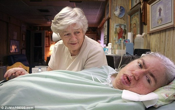 Vì biến chứng của bệnh viêm phổi mà năm 17 tuổi, Edwarda đã rơi vào trạng thái hôn mê và bà Kaye đã chăm sóc Edwarda trong 35 năm, cho tới khi bà qua đời