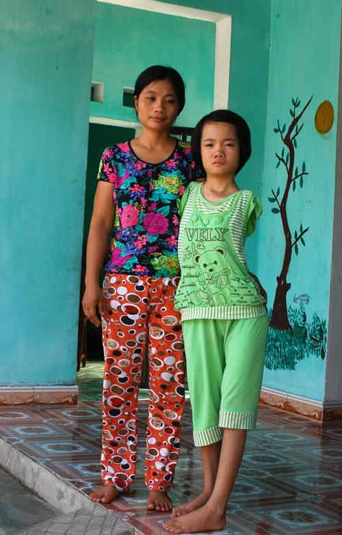 Nguôi đi nỗi đau sinh con ra không có cả hai cánh tay, chị Tình hiện rõ nỗi buồn khi nhìn đứa con gái càng lớn càng bị vẹo cột sống và hai chân không đều nhau