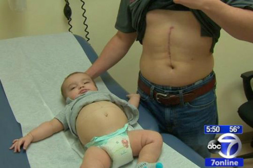 Cậu bé khỏe mạnhsau phẫu thuật với dấu tích từ việchiến tạng của ngườibố. Ảnh:ABC Inc. 55_1437968074.jpg