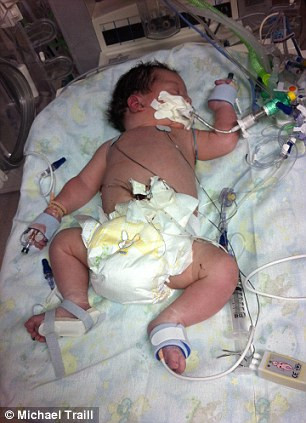 Bé Keira đã phải chịu đựng nhiều cuộc phẫu thuật đau đớn để giữ mạng sống