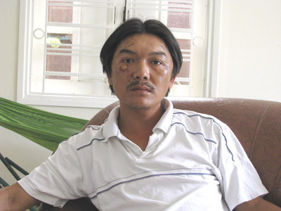 Nguyễn Văn Cường với khuôn mặt đầy sẹo sau tai nạn kinh hoàng