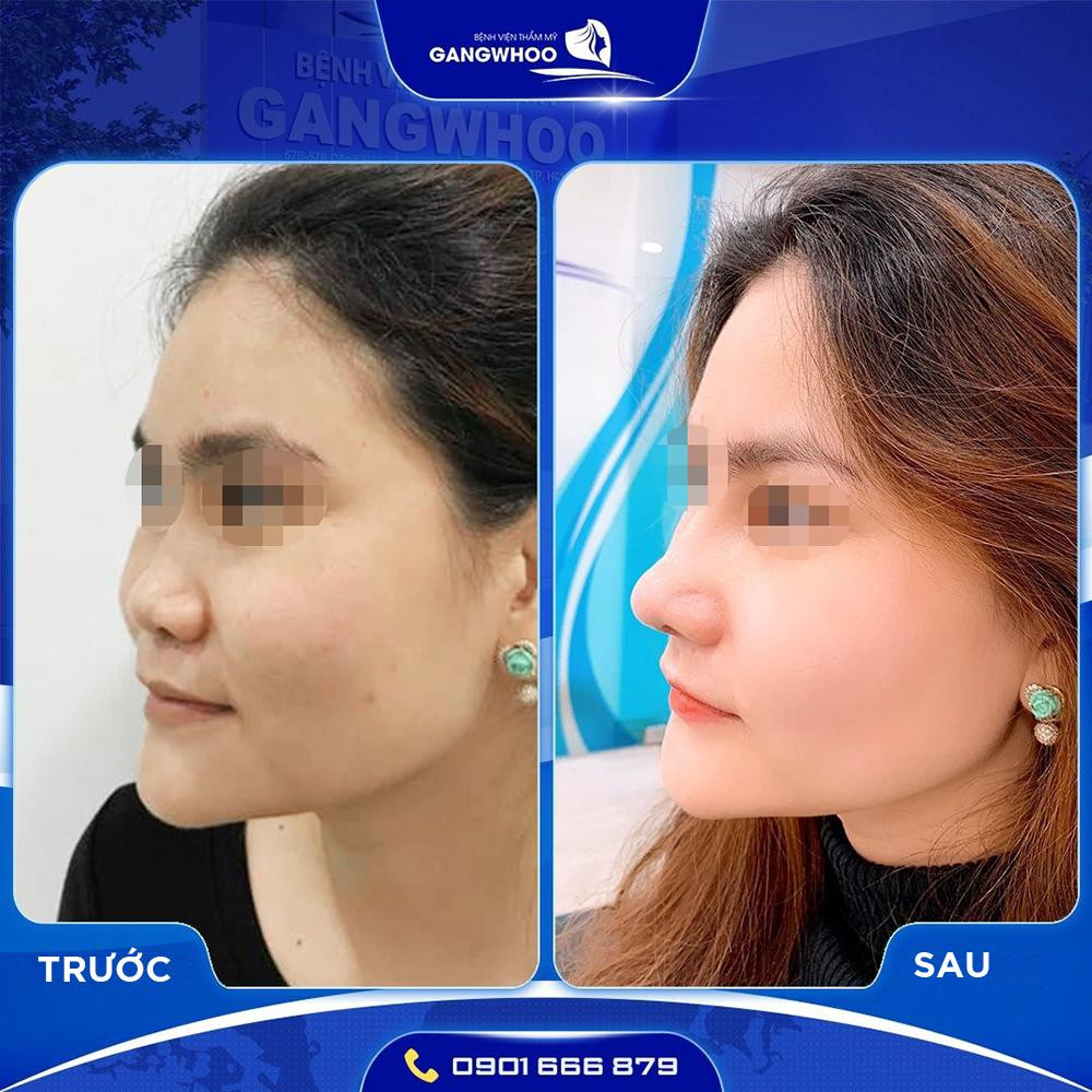 Khách hàng tự tin khoe nhan sắc sau nâng mũi Surgiform tại BVTM Gangwhoo