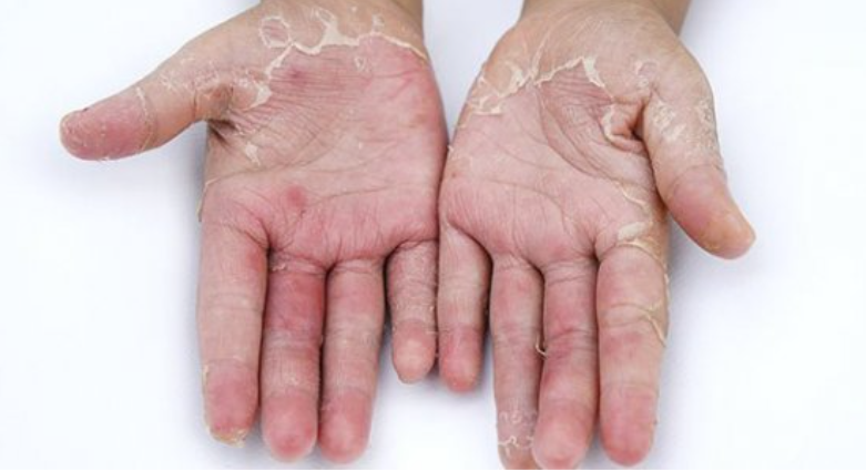 Bệnh da vảy cá khiến các mảng da bong tróc ngứa rát rất khó chịu Bệnh da vảy cá khiến các mảng da bong tróc ngứa rát rất khó chịu