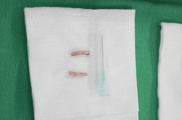 Hình ảnh xương mỏm trâm sau khi được loại bỏ