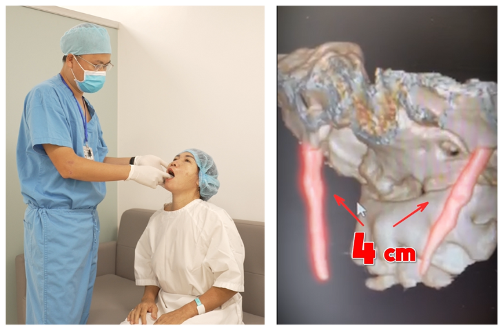 Qua phim CT Scan 3D phát hiện xương mỏm trâm dài 4cm