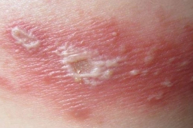 Tổn thương do kiến ba khoang đốt Tổn thương do kiến ba khoang đốt