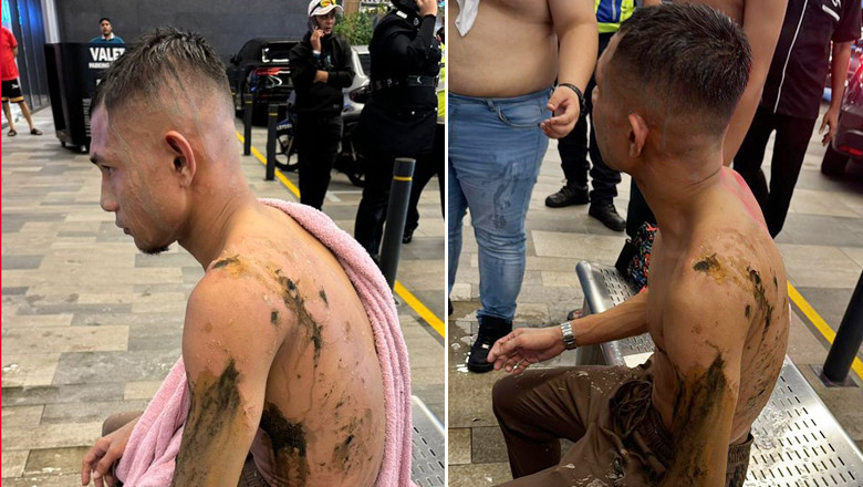 Những vết thương của Halim do bị tạt axit