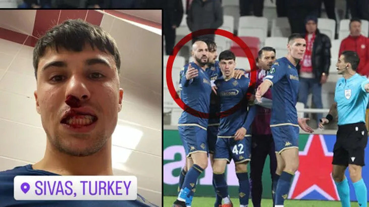 Bianco và chiếc mũi bị gãy sau khi bị CĐV tấn công