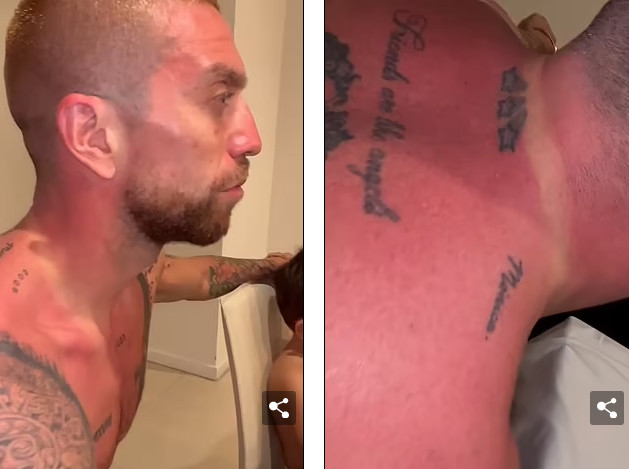 Gomez cho thấy phần da nắng rát sau khi đi &quot;khoe&quot; cúp