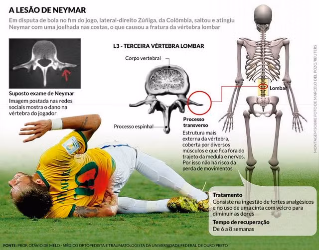 ĐỒ HỌA: Neymar đã dính chấn thương như thế nào? ảnh 2