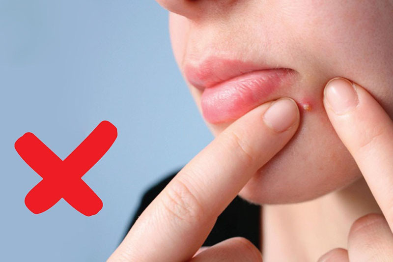 Không tự ý nặn mụn vì nặn mụn không đúng cách có thể để lại sẹo, thâm. Không tự ý nặn mụn vì nặn mụn không đúng cách có thể để lại sẹo, thâm.