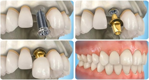 Trồng răng cấm giá bao nhiêu là chuẩn nhất? ảnh 2