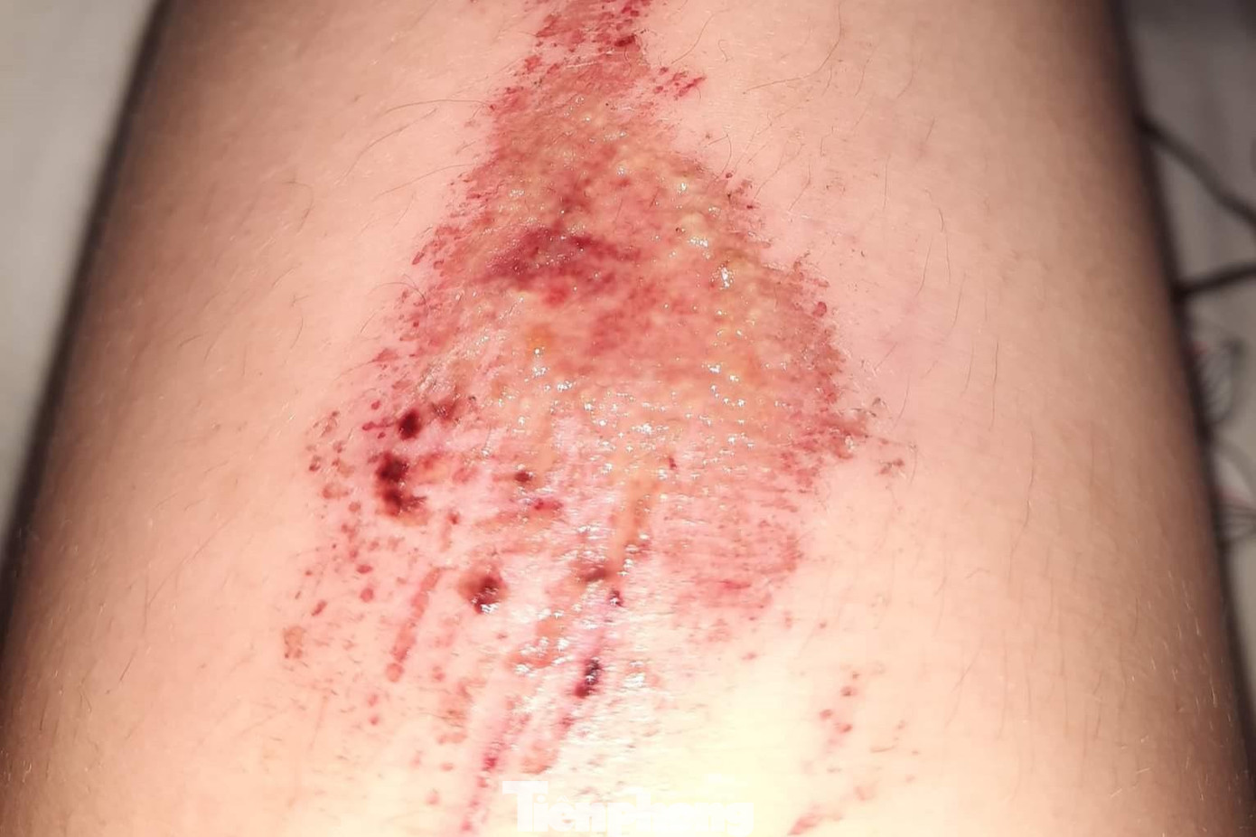 Vết thương chị T.V.T lúc bị tai nạn (Ảnh: NVCP) Vết thương chị T.V.T lúc bị tai nạn (Ảnh: NVCP)