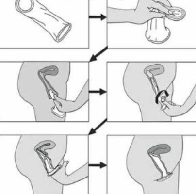 Cách dùng bao cao su cho nữ đúng cách.