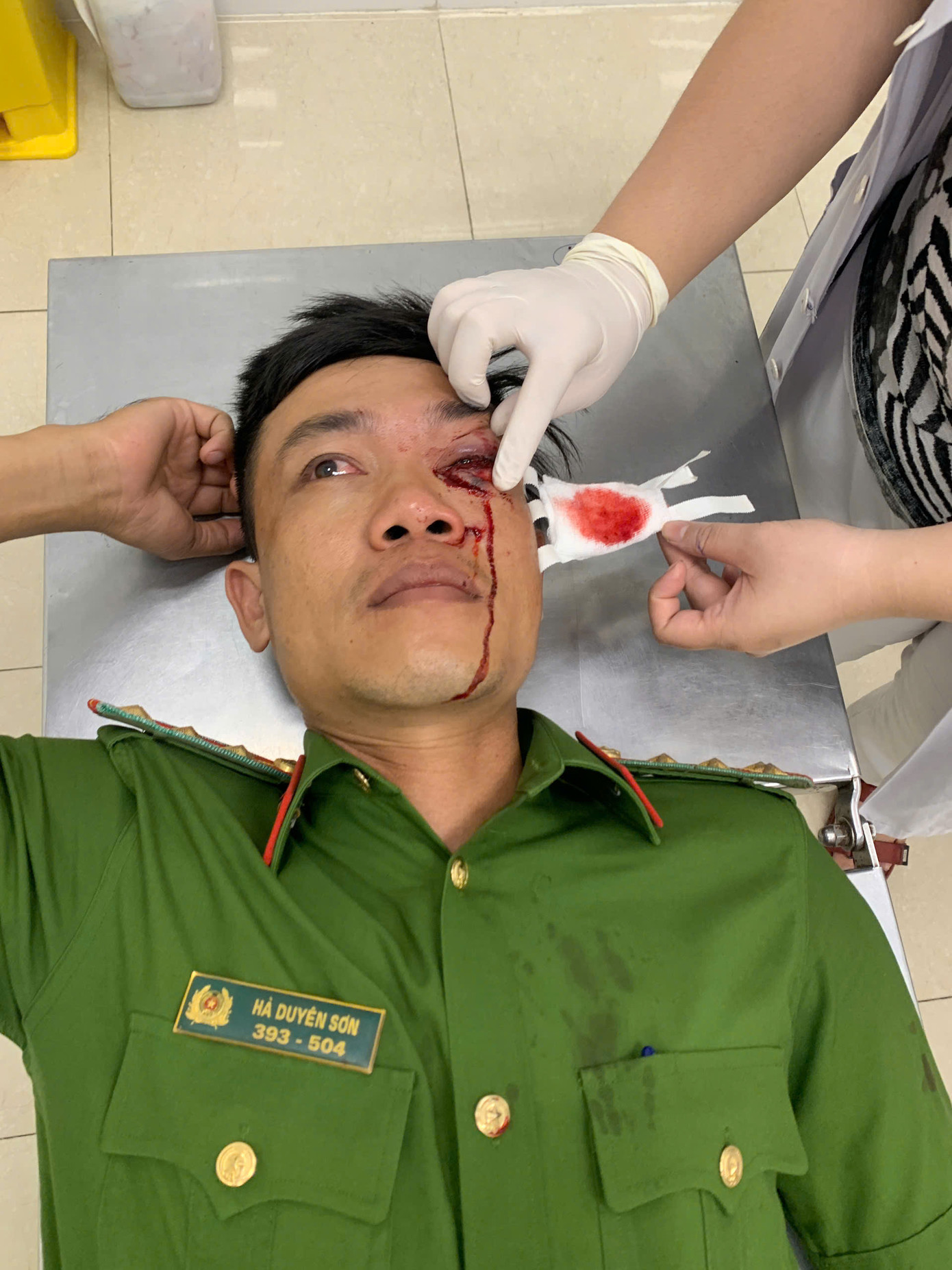 Đại uý Hà Duyên Sơn bị thương ở vùng mắt trái.