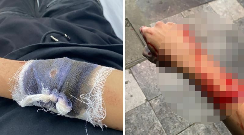 M. bị thương tích ở tay. M. bị thương tích ở tay.