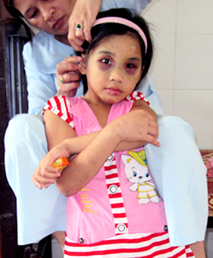 Bé Phi dần hồi phục