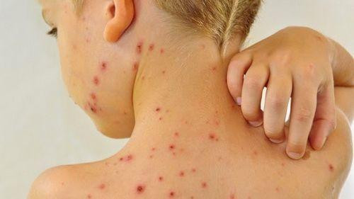 Các bệnh ngoài da do virus và giải pháp hay từ sản phẩm cốm Subạc ảnh 2