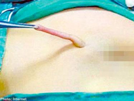 Chiếc đuôi thừa dài 6cm hiện đã được phẫu thuật cắt bỏ. Ảnh: Stomp