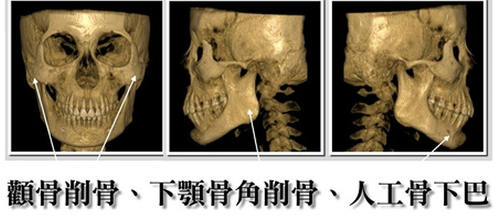 Hình ảnh minh hoạ các bước phải thực hiện trong quá trình phẫu thuật