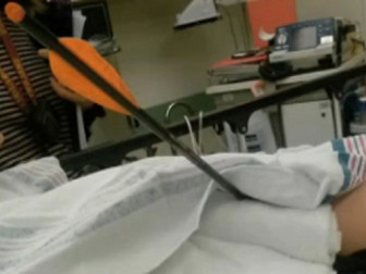 Mũi tên đâm vào đùi học sinh 8 tuổi khi em đang vui chơi tại khuôn viên trường. 