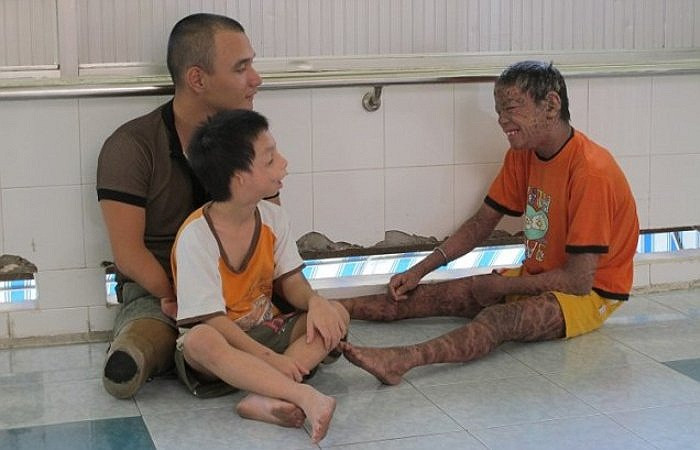 Trước đó, báo chí cũng đưa tin về một cậu bé mồ côi tên Minh Anh, 18 tuổi tại Việt Nam mắc căn bệnh này