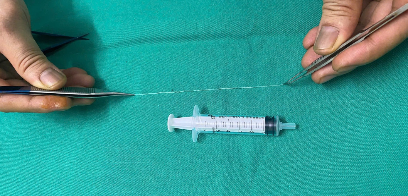 Giun chỉ sau khi được gắp ra ngoài Giun chỉ sau khi được gắp ra ngoài