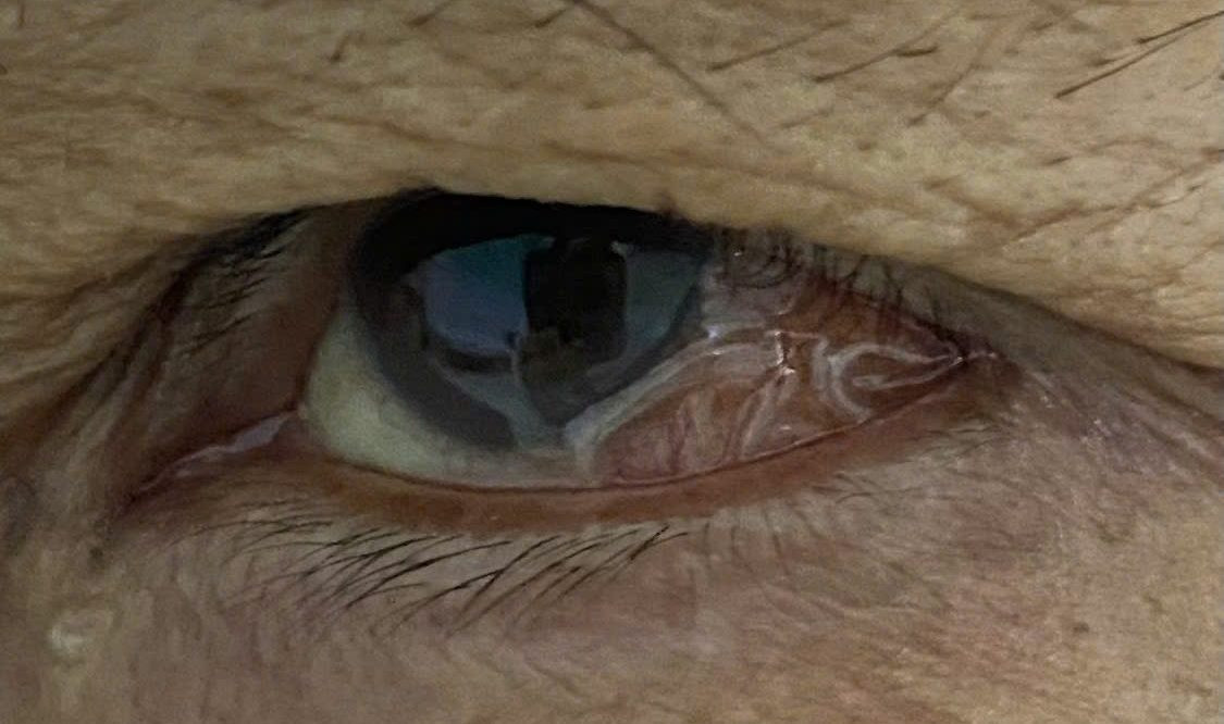 Mắt của bệnh nhân trước khi được gắp con giun ra ngoài Mắt của bệnh nhân trước khi được gắp con giun ra ngoài