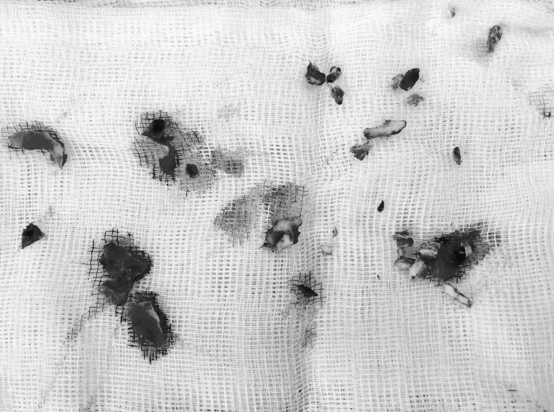 Những mảnh xương sọ bị vỡ cùng nhu mô não được bác sĩ phẫu thuật loại bỏ Những mảnh xương sọ bị vỡ cùng nhu mô não được bác sĩ phẫu thuật loại bỏ