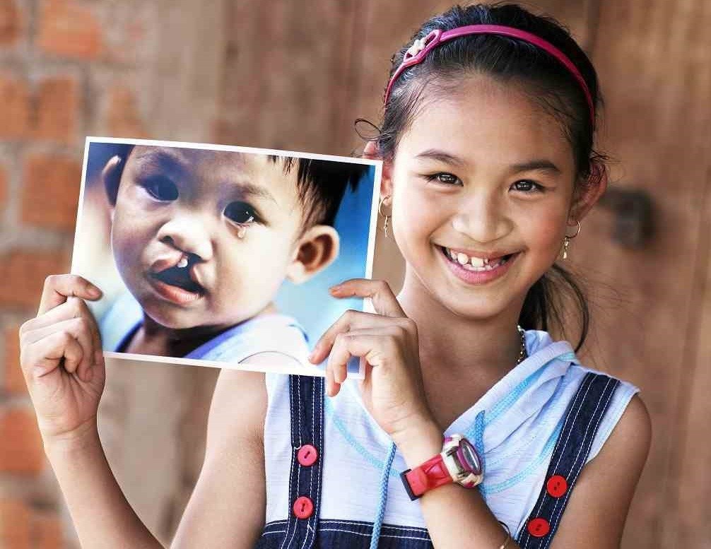 Phẫu thuật là giải pháp hiệu quả nhất giúp bệnh nhân bị khe hở môi, hàm ếch có cuộc sống bình thường Phẫu thuật là giải pháp hiệu quả nhất giúp bệnh nhân bị khe hở môi, hàm ếch có cuộc sống bình thường